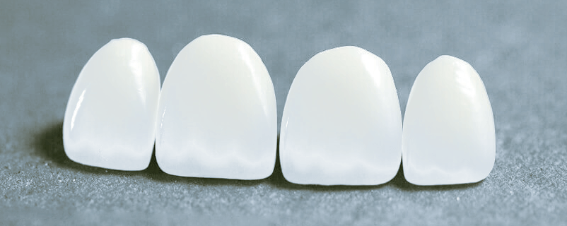 Виниры - керамические накладки на зубы